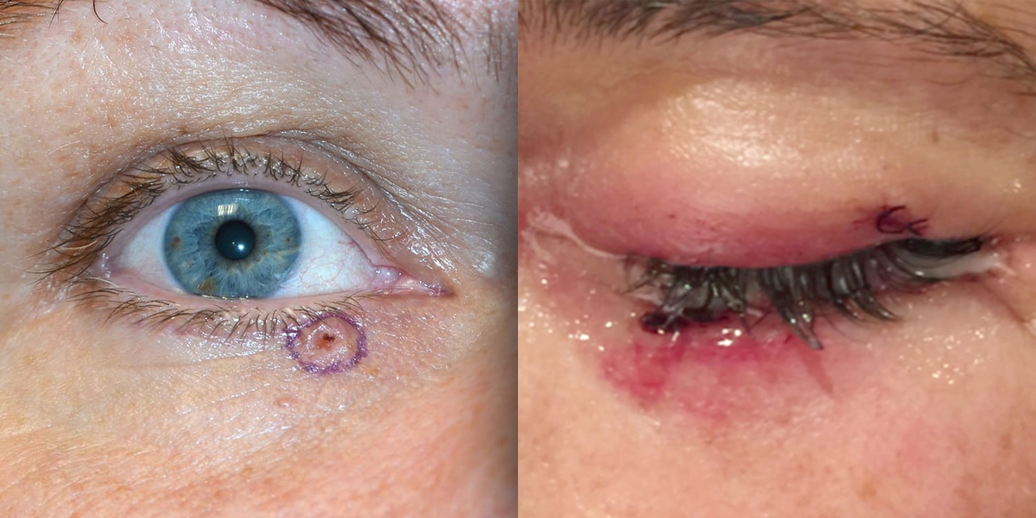Smeared Mascara Beauty Mark Eyelid Bump Were Skin Cancer