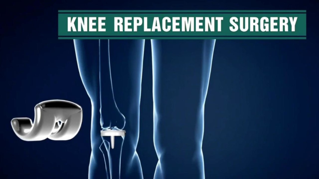 Image result for knee replacement