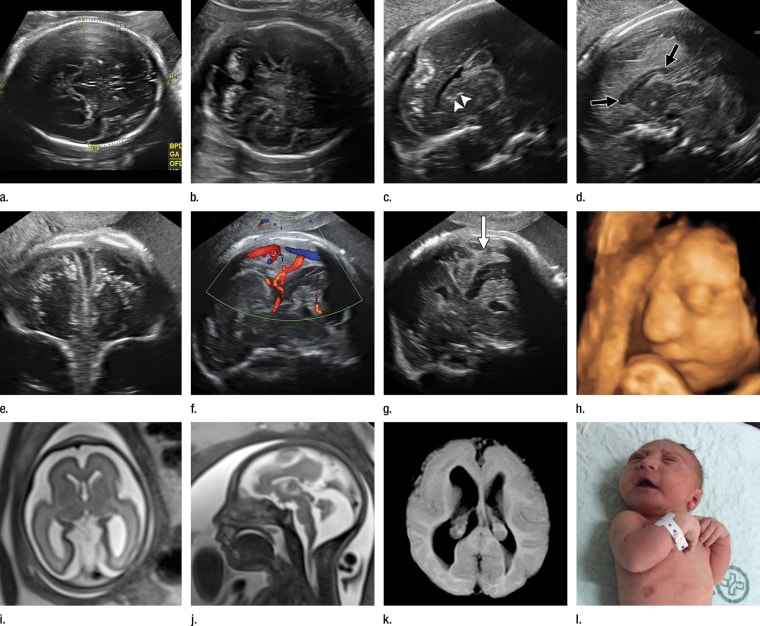 Images obtained in the case of a 34-year-old woman with confirmed Zika virus infection, initially seen for a rash at 8 weeks of gestation. Fetal head circumference was in the normal range at 12 and 16 weeks but then decreased to the 10th percentile at 22 weeks and was below the 3rd percentile in subsequent imaging examinations. Photograph of the neonate after birth.