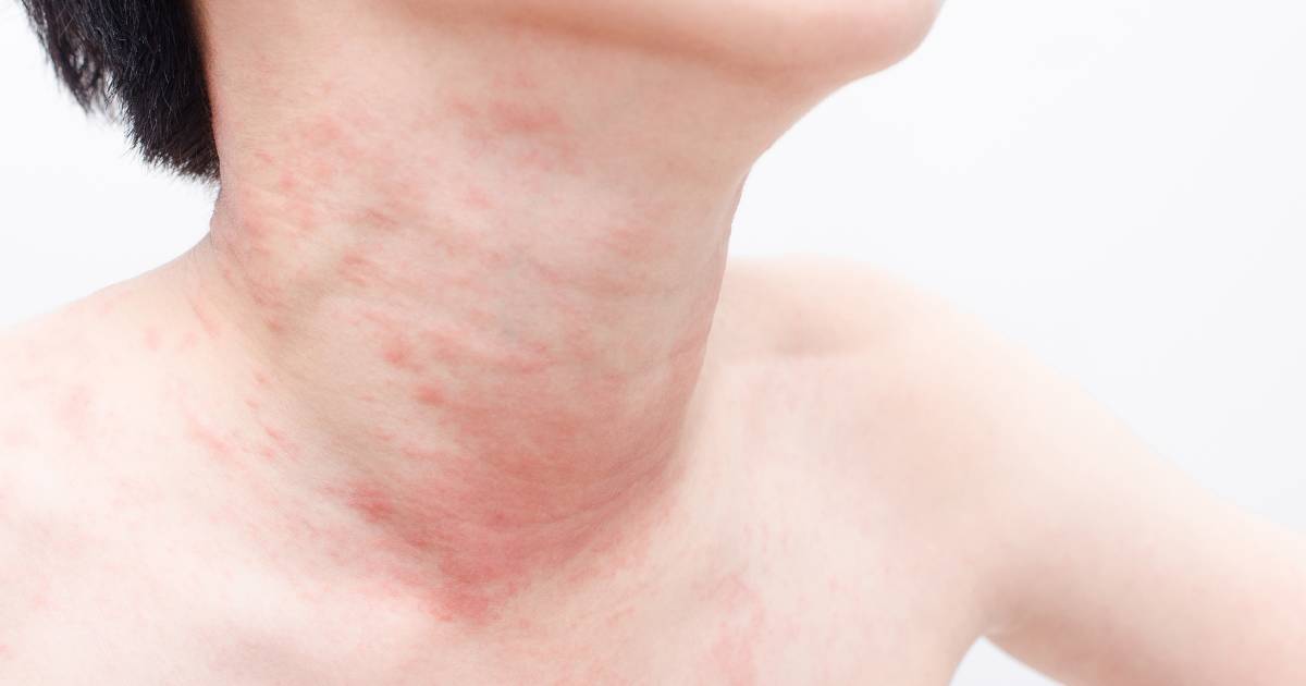 Unusual flu symptoms: Can skin hives be a flu warning sign?