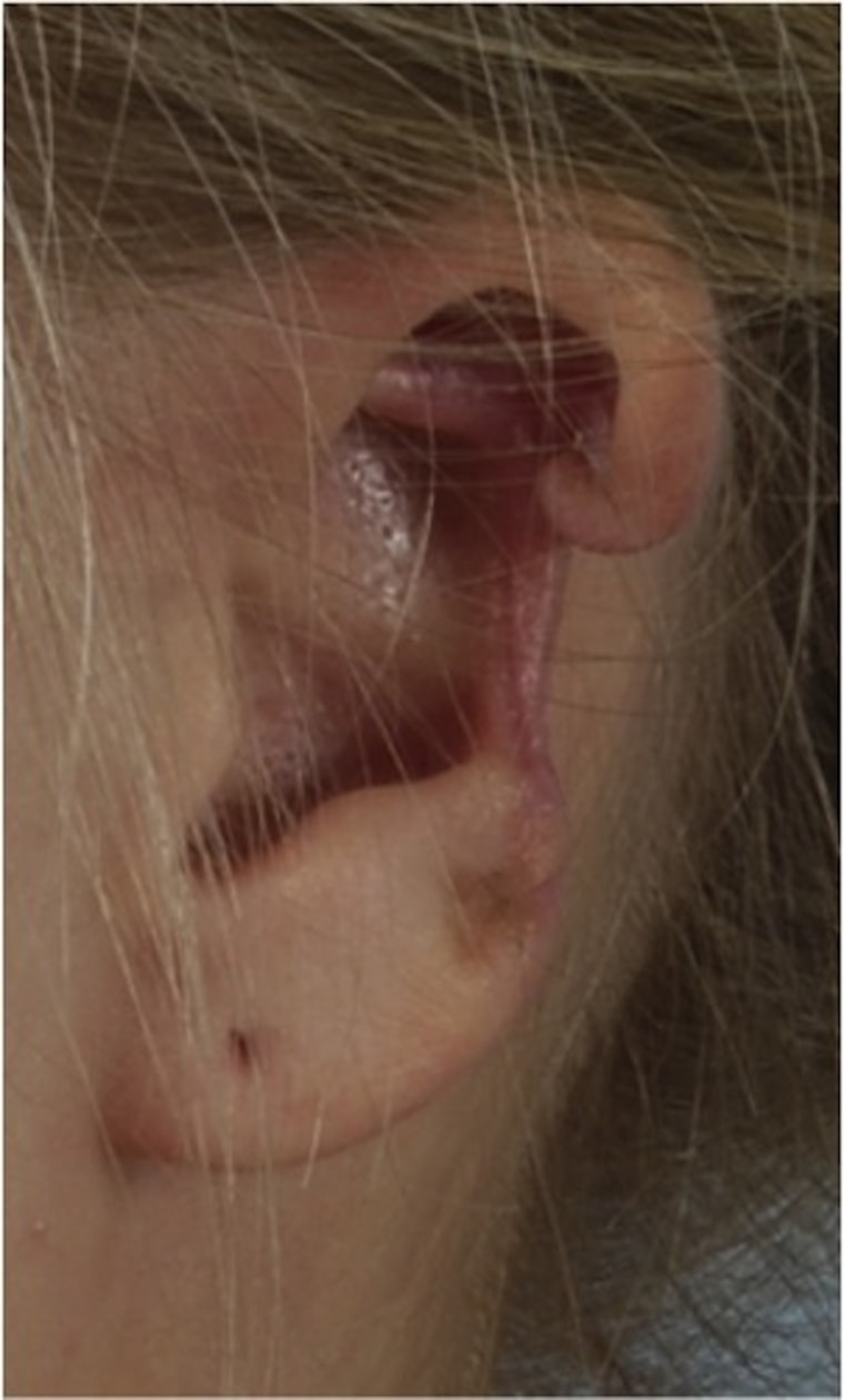 Recluse Spider Bite Eats Hole In Young Woman S Ear